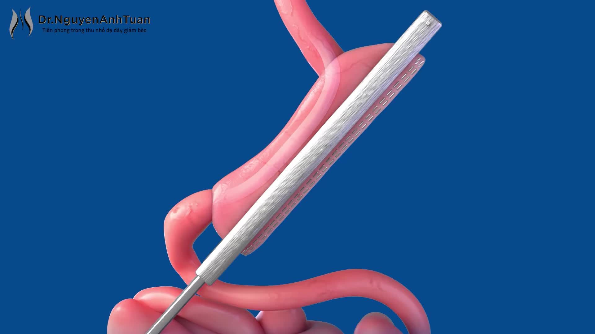 Phẫu thuật thu nhỏ dạ dày hình ống đã được Hiệp hội Giảm cân Hoa Kỳ chứng nhận là phương pháp giảm cân hiệu quả, an toàn và bền vững nhất hiện nay.